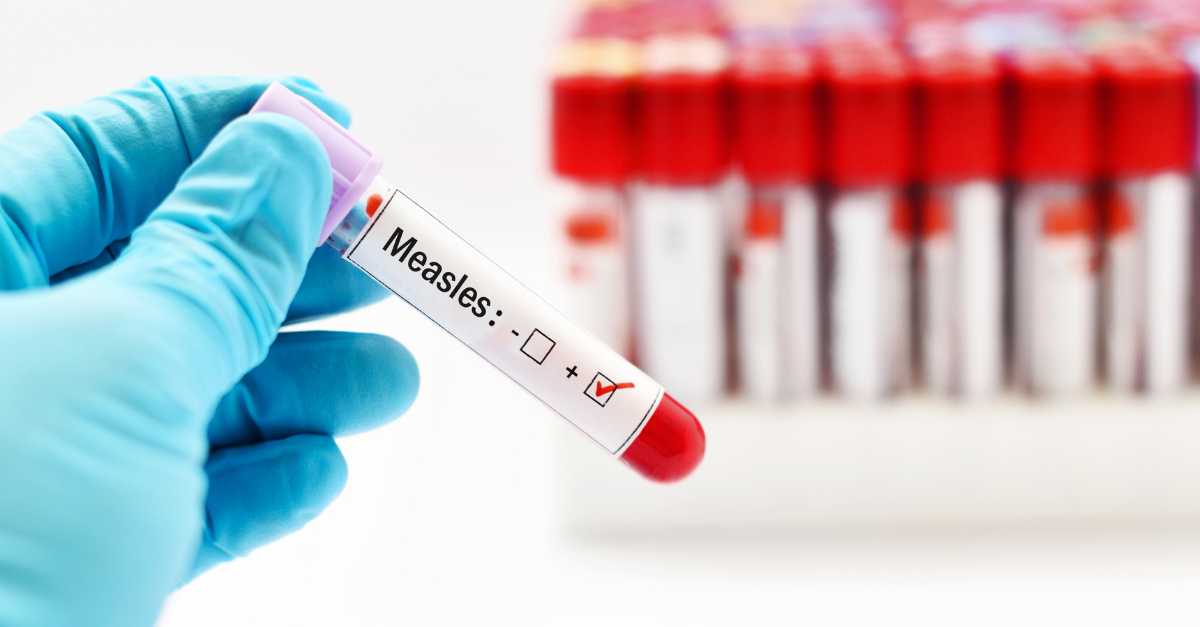 measles sample collection